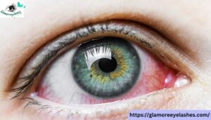 How to Treat Red Eyes After Eyelash Extensions