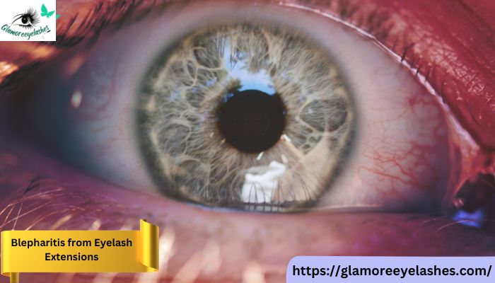 Blepharitis from Eyelash Extensions